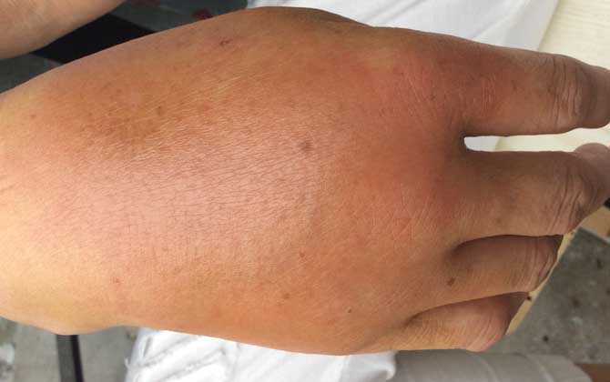 被虎頭蜂蟄了的人會怎樣?看圖片都疼,珍愛生命,遠(yuǎn)離虎頭蜂! 被虎頭蜂蟄