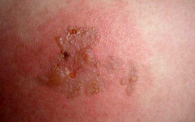 被虎頭蜂蟄了的人會怎樣?看圖片都疼,珍愛生命,遠(yuǎn)離虎頭蜂! 被虎頭蜂蟄