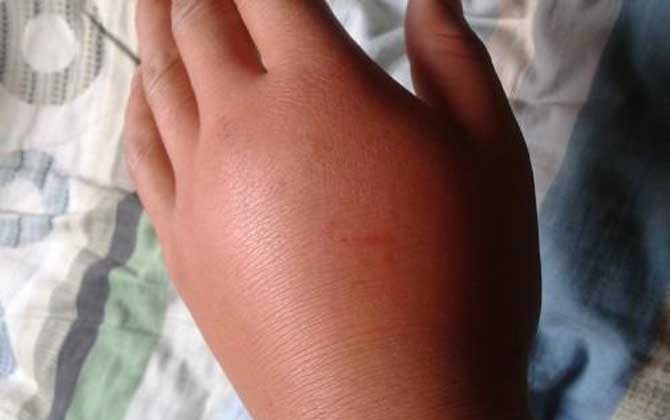 被虎頭蜂蟄了的人會怎樣?看圖片都疼,珍愛生命,遠(yuǎn)離虎頭蜂! 被虎頭蜂蟄