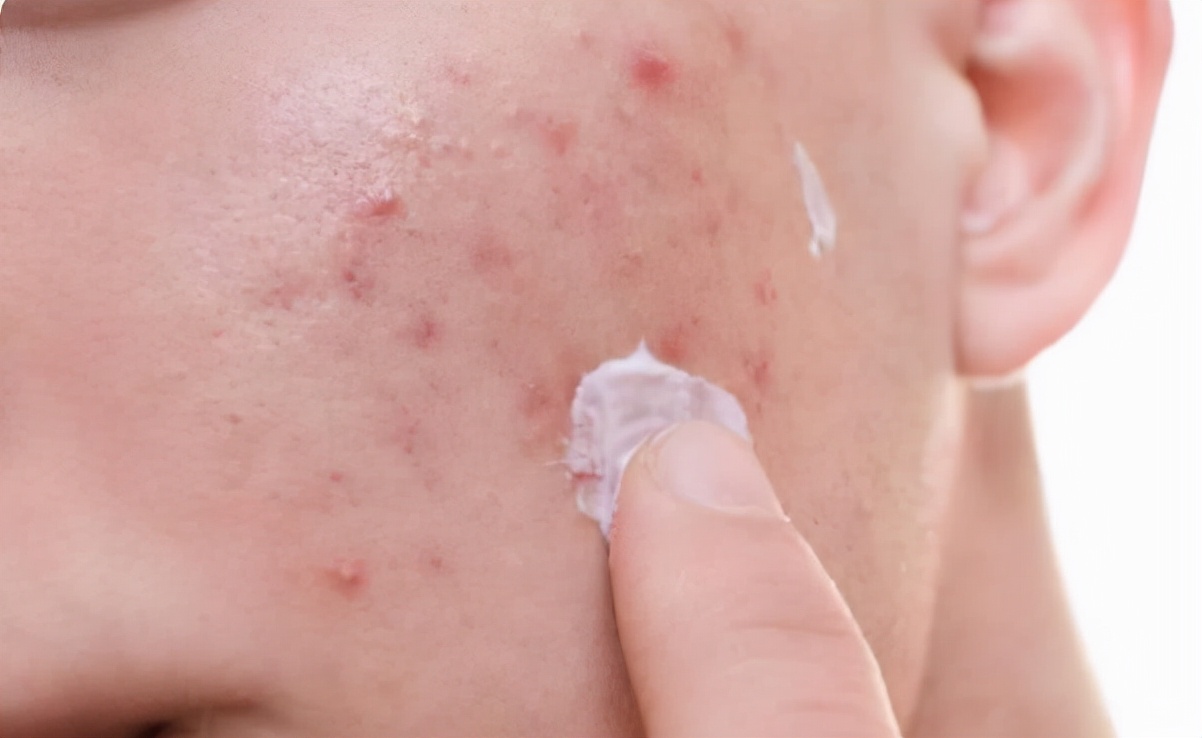 油性皮膚毛孔粗大怎么辦 面部皮膚油膩?學(xué)會(huì)這3個(gè)洗臉小技巧,讓你遠(yuǎn)離“毛孔粗大”煩惱