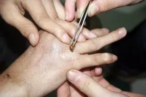 被蜜蜂蜇傷怎么辦(蜜蜂蟄傷了怎么處理) 被蜜蜂蜇傷怎么辦(蜜蜂蟄傷了怎么處理)