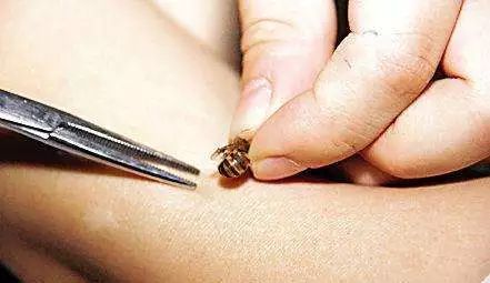 黃蜂的毒液是酸性還是堿性（黃蜂毒液性狀和被蟄后的應急處理）